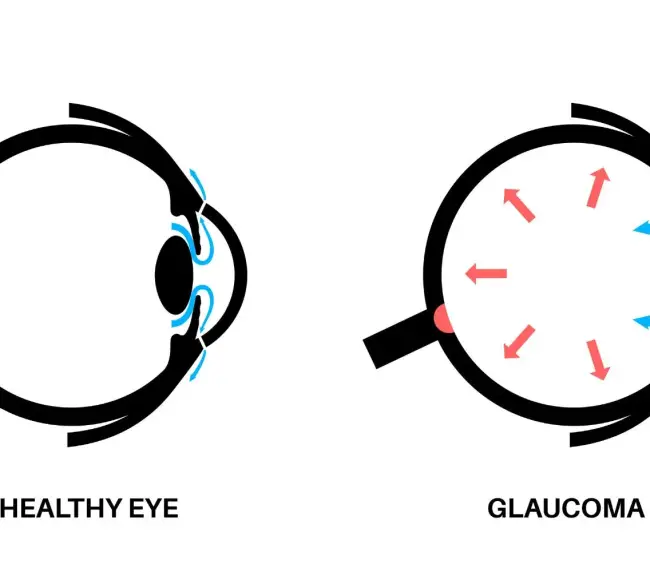 Understanding Glaucoma The Role of Beta-blockers in Eye Health - Clarity Vision