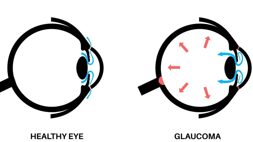 Understanding Glaucoma The Role of Beta-blockers in Eye Health - Clarity Vision