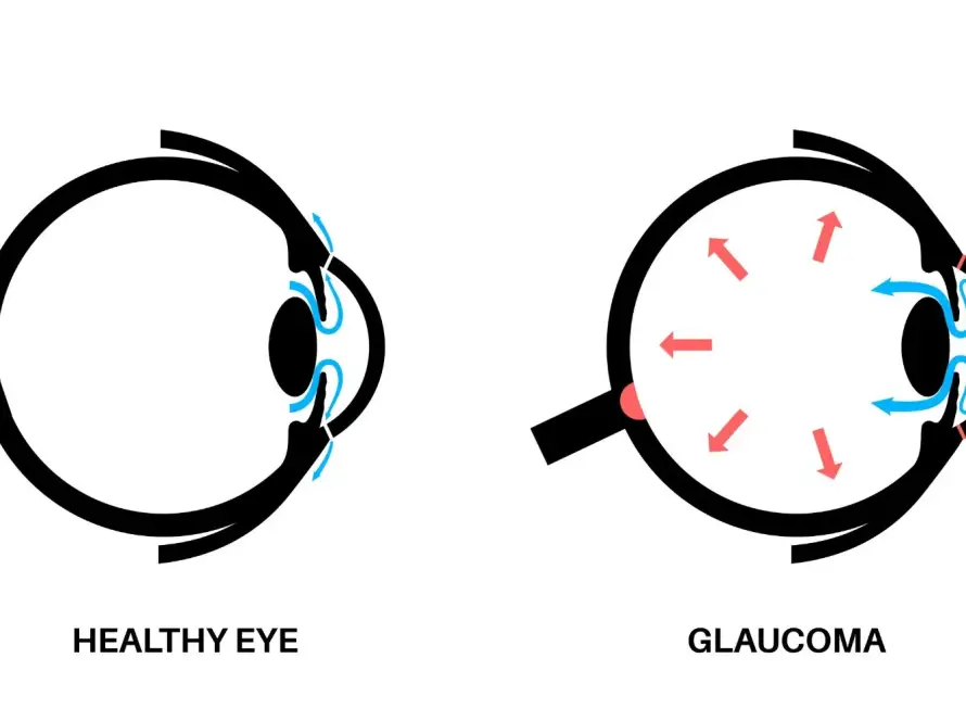 Understanding Glaucoma The Role of Beta-blockers in Eye Health - Clarity Vision