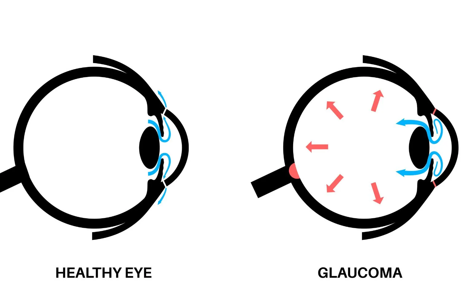 Understanding Glaucoma The Role of Beta-blockers in Eye Health - Clarity Vision